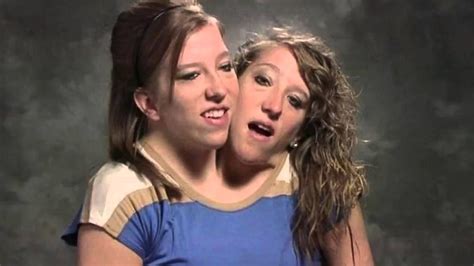 nude conjoined twins|real conjoined twins Search